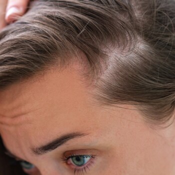 Woman suffering from hair loss