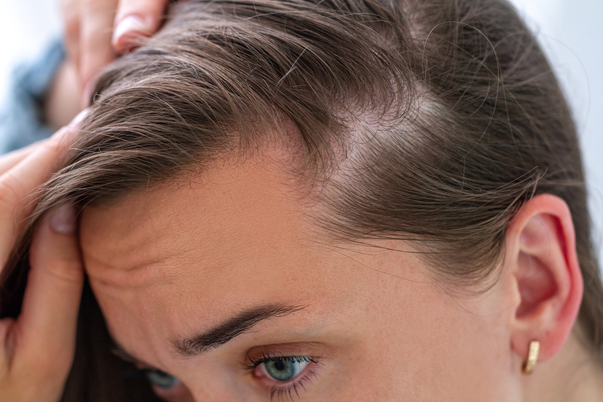 Woman suffering from hair loss